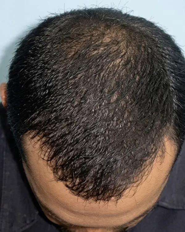 Hair loss treatment after result